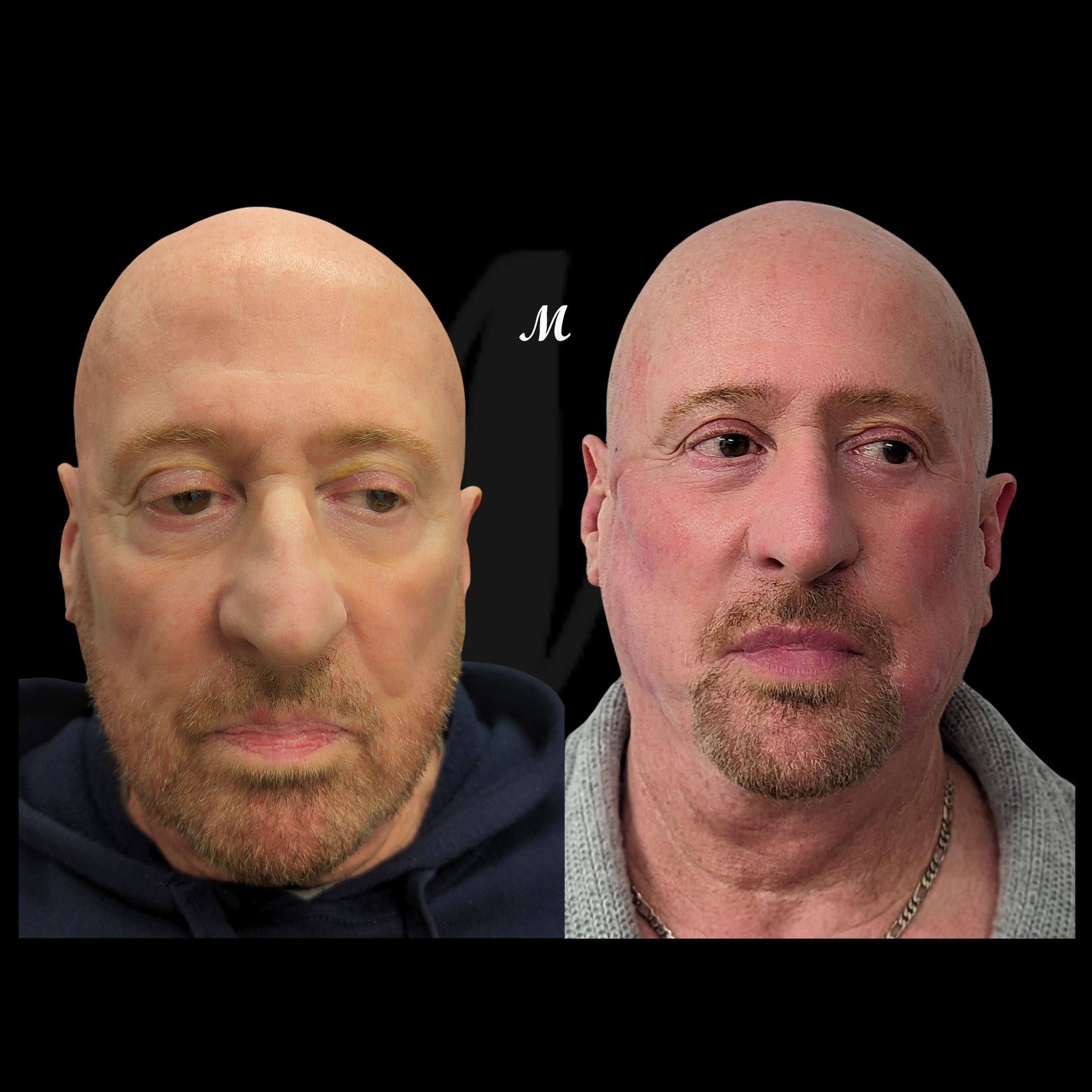 Eye Thread Lift